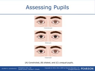 Copyright © 2016, 2012, 2009 by Pearson Education, Inc.
All Rights Reserved
Emergency Care, 13e
Daniel Limmer | Michael F. O'Keefe
Assessing Pupils
(A) Constricted, (B) dilated, and (C) unequal pupils.
 