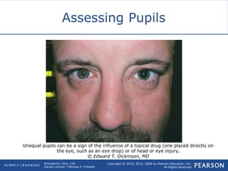 Copyright © 2016, 2012, 2009 by Pearson Education, Inc.
All Rights Reserved
Emergency Care, 13e
Daniel Limmer | Michael F. O'Keefe
Assessing Pupils
Unequal pupils can be a sign of the influence of a topical drug (one placed directly on
the eye, such as an eye drop) or of head or eye injury.
© Edward T. Dickinson, MD
 