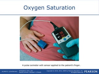 Copyright © 2016, 2012, 2009 by Pearson Education, Inc.
All Rights Reserved
Emergency Care, 13e
Daniel Limmer | Michael F. O'Keefe
Oxygen Saturation
A pulse oximeter with sensor applied to the patient's finger.
 