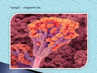  Fungal :- ringworm etc.
 
