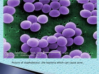 Picture of staphylococci ,the bacteria which can cause acne .
 