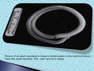 Picture of an adult roundworm (Ascaris lumbricoides is the technical name )
From the small intestine .The ruler next to it shows
 