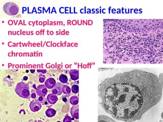 PLASMA CELL classic features
• OVAL cytoplasm, ROUND
nucleus off to side
• Cartwheel/Clockface
chromatin
• Prominent Golgi or “Hoff”
 