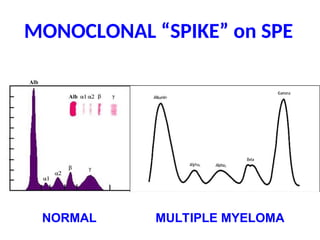 MONOCLONAL “SPIKE” on SPE
NORMAL MULTIPLE MYELOMA
 