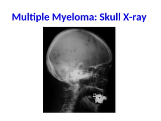 Multiple Myeloma: Skull X-ray
 