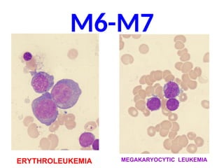 M6-M7
ERYTHROLEUKEMIA MEGAKARYOCYTIC LEUKEMIA
 