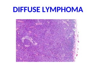 DIFFUSE LYMPHOMA
 