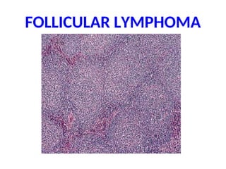 FOLLICULAR LYMPHOMA
 