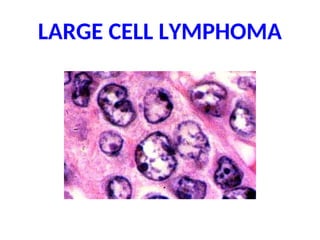 LARGE CELL LYMPHOMA
 