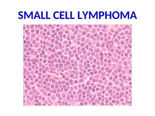 SMALL CELL LYMPHOMA
 