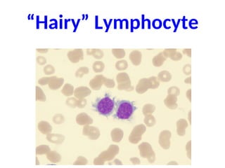 “Hairy” Lymphocyte
 