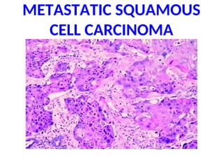 METASTATIC SQUAMOUS
CELL CARCINOMA
 