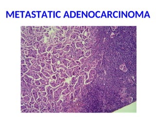 METASTATIC ADENOCARCINOMA
 