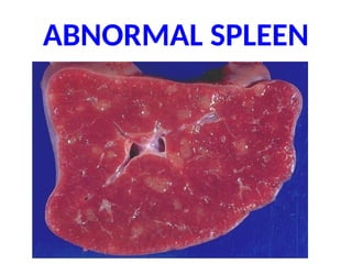 ABNORMAL SPLEEN
 