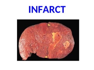 INFARCT
 