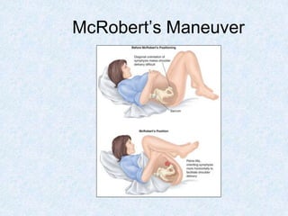 McRobert’s Maneuver
 