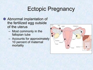 Ectopic Pregnancy
Abnormal implantation of
the fertilized egg outside
of the uterus
– Most commonly in the
fallopian tube
– Accounts for approximately
10 percent of maternal
mortality
 