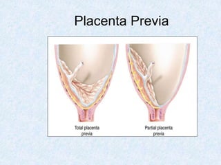 Placenta Previa
 