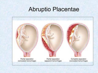 Abruptio Placentae
 