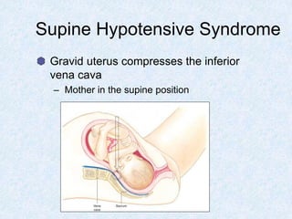 Supine Hypotensive Syndrome
Gravid uterus compresses the inferior
vena cava
– Mother in the supine position
 