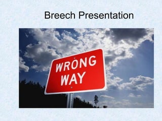 Breech Presentation
 