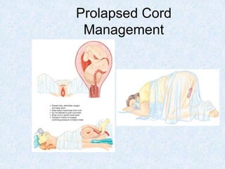 Prolapsed Cord
Management
 