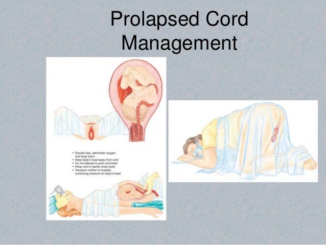 ob tcc prolapsed cord