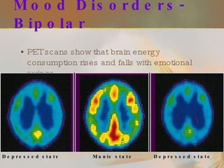 Mood Disorders-Bipolar PET scans show that brain energy consumption rises and falls with emotional swings Depressed state Manic state Depressed state 