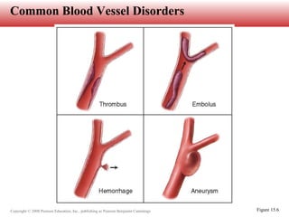 Copyright © 2008 Pearson Education, Inc., publishing as Pearson Benjamin Cummings
Common Blood Vessel Disorders
Figure 15.6
 