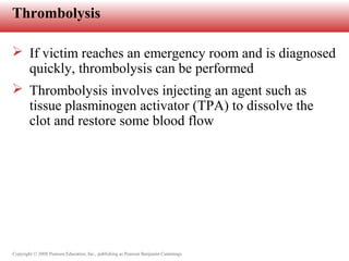 Copyright © 2008 Pearson Education, Inc., publishing as Pearson Benjamin Cummings
Thrombolysis
 If victim reaches an emergency room and is diagnosed
quickly, thrombolysis can be performed
 Thrombolysis involves injecting an agent such as
tissue plasminogen activator (TPA) to dissolve the
clot and restore some blood flow
 
