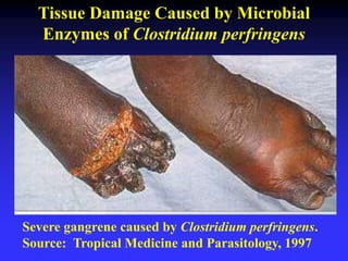 Severe gangrene caused by Clostridium perfringens.
Source: Tropical Medicine and Parasitology, 1997
Tissue Damage Caused by Microbial
Enzymes of Clostridium perfringens
 