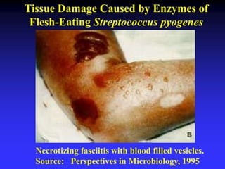 Necrotizing fasciitis with blood filled vesicles.
Source: Perspectives in Microbiology, 1995
Tissue Damage Caused by Enzymes of
Flesh-Eating Streptococcus pyogenes
 
