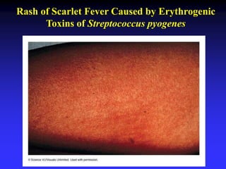Rash of Scarlet Fever Caused by Erythrogenic
Toxins of Streptococcus pyogenes
 