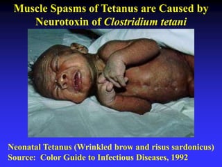 Neonatal Tetanus (Wrinkled brow and risus sardonicus)
Source: Color Guide to Infectious Diseases, 1992
Muscle Spasms of Tetanus are Caused by
Neurotoxin of Clostridium tetani
 