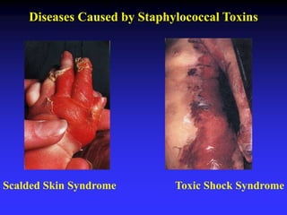 Diseases Caused by Staphylococcal Toxins
Scalded Skin Syndrome Toxic Shock Syndrome
 