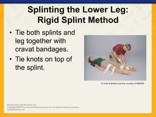 Splint With Rope Ch16 presentation splinting_extremities | PPTX