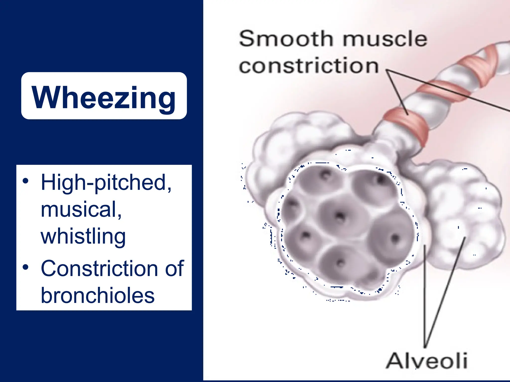 • High-pitched,
musical,
whistling
• Constriction of
bronchioles
Wheezing
 