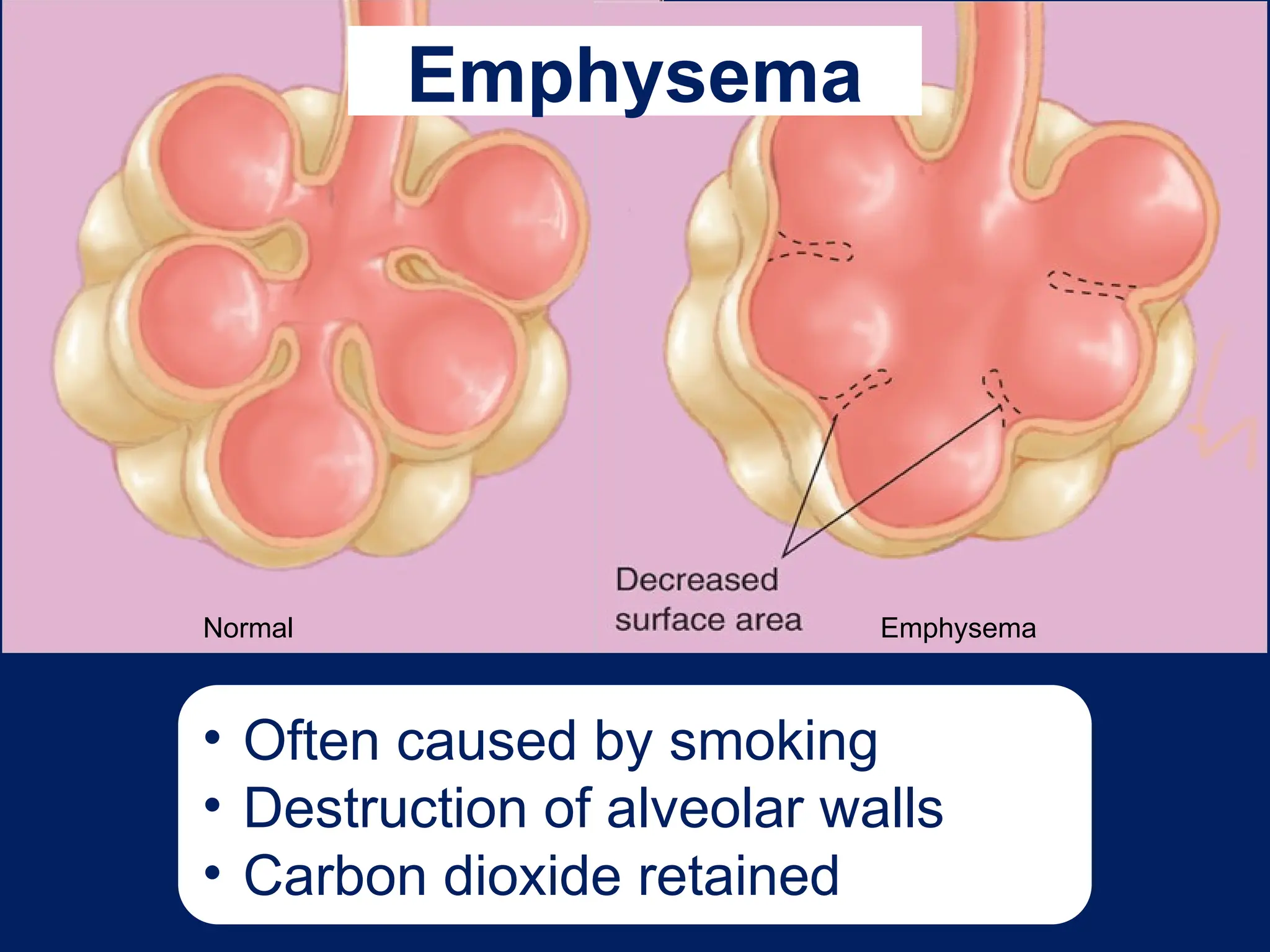 Emphysema
Normal
• Often caused by smoking
• Destruction of alveolar walls
• Carbon dioxide retained
Emphysema
 