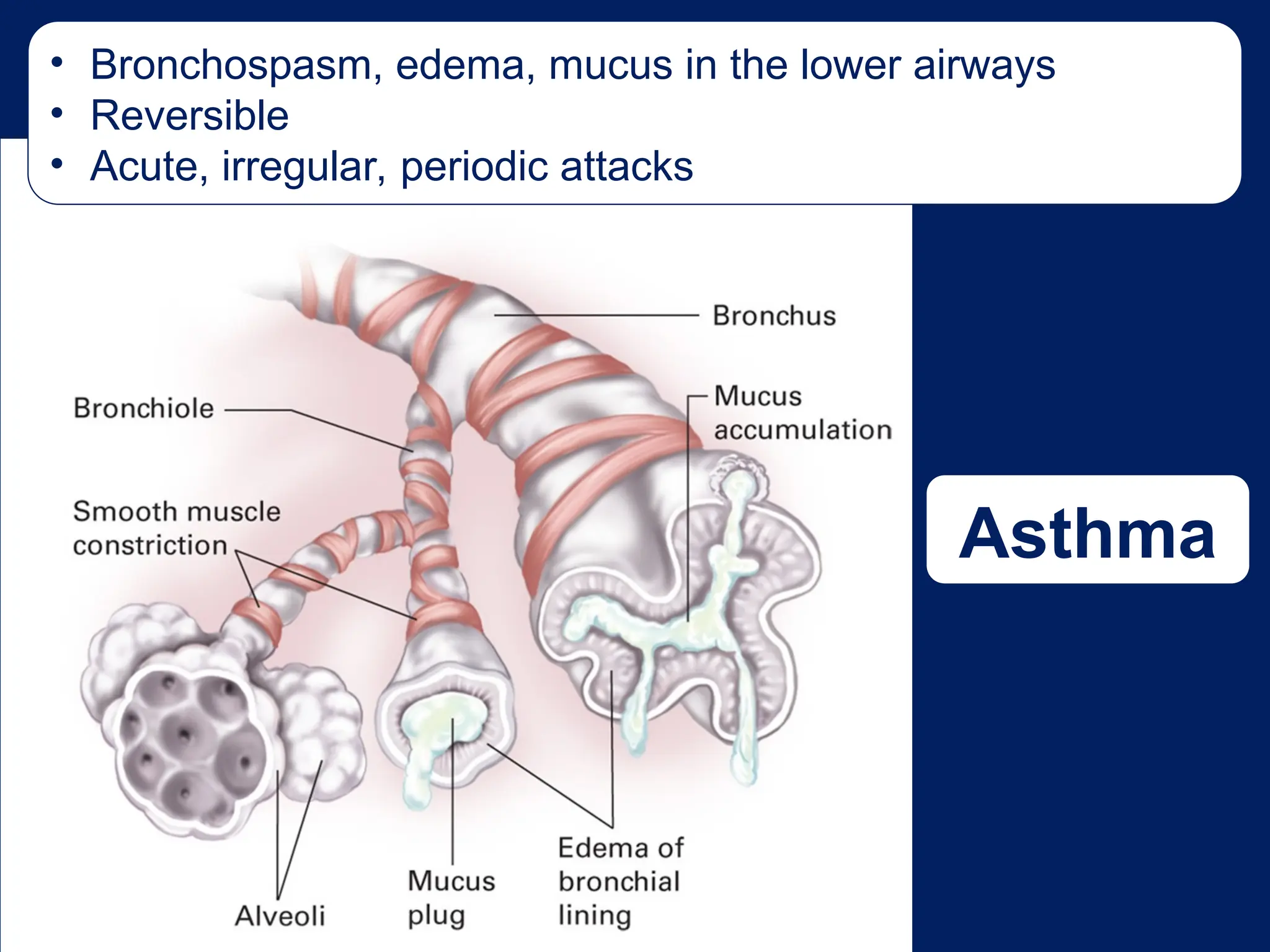 • Bronchospasm, edema, mucus in the lower airways
• Reversible
• Acute, irregular, periodic attacks
Asthma
 
