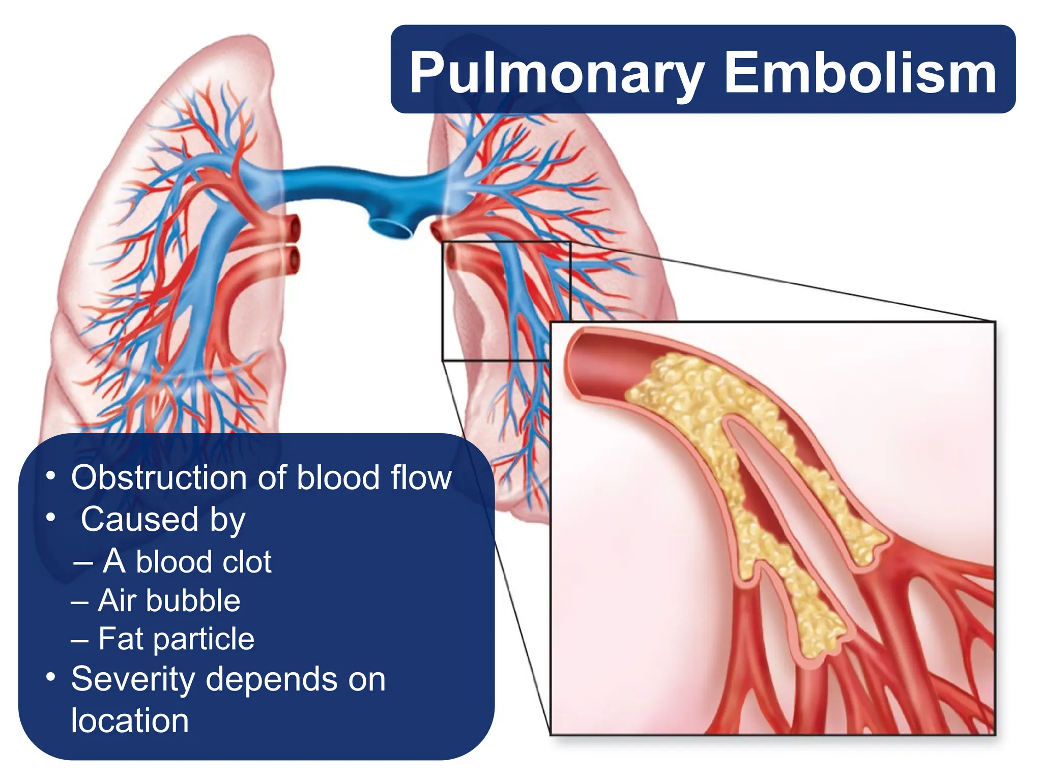 Pulmonary Embolism
• Obstruction of blood flow
• Caused by
– A blood clot
– Air bubble
– Fat particle
• Severity depends on
location
 