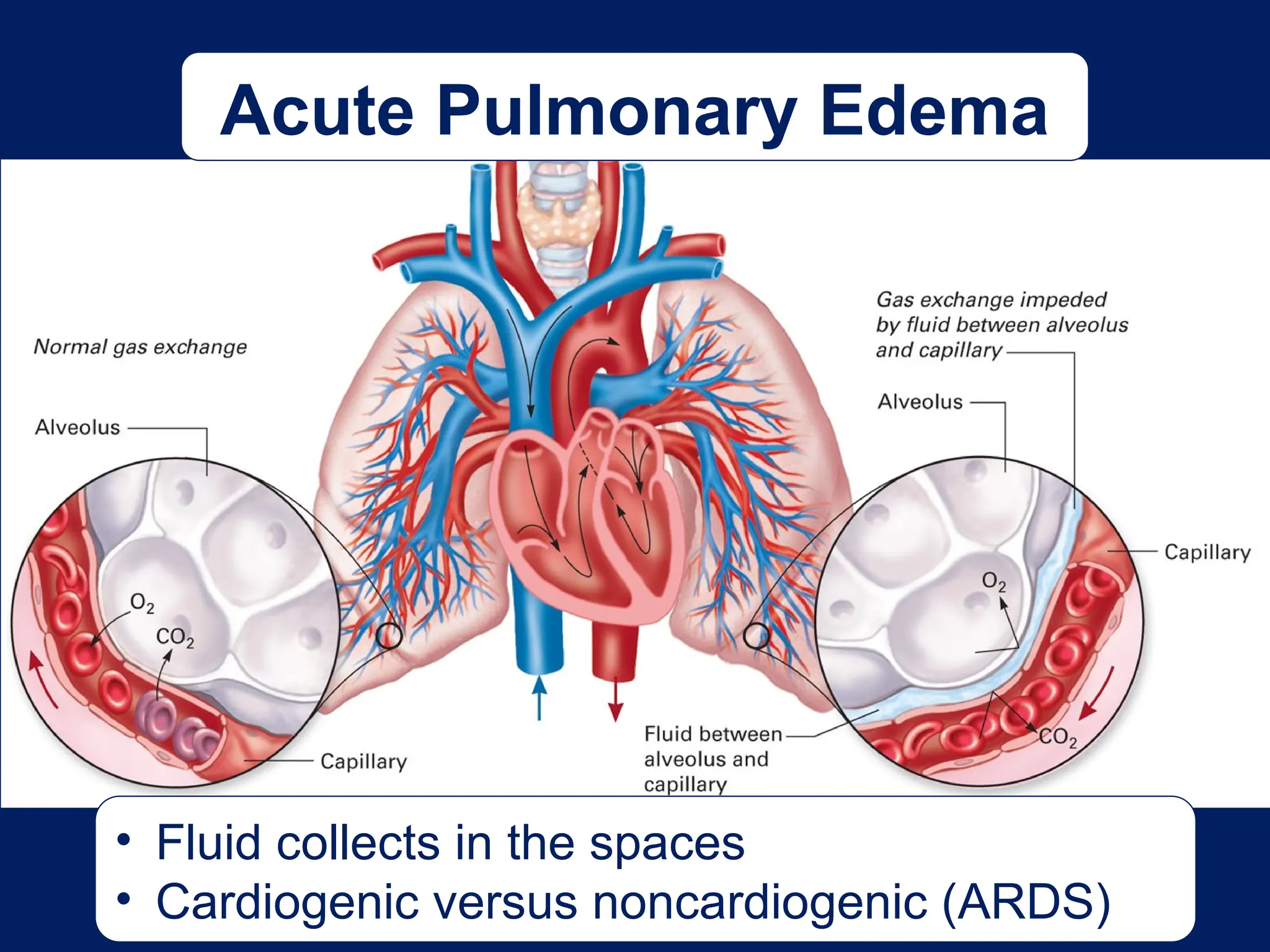 Acute Pulmonary Edema
• Fluid collects in the spaces
• Cardiogenic versus noncardiogenic (ARDS)
 