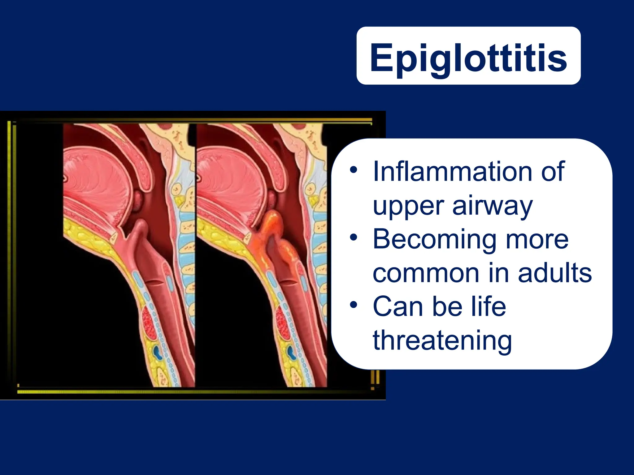 Epiglottitis
• Inflammation of
upper airway
• Becoming more
common in adults
• Can be life
threatening
 