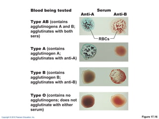 Figure 17.16 Serum Anti-A RBCs Anti-B Type AB  (contains agglutinogens A and B; agglutinates with both sera) Blood being tested Type A  (contains agglutinogen A; agglutinates with anti-A) Type B  (contains agglutinogen B; agglutinates with anti-B) Type O   (contains no agglutinogens; does not agglutinate with either serum) 