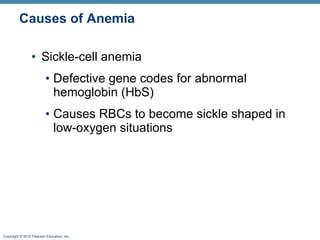 Causes of Anemia Sickle-cell anemia Defective gene codes for abnormal hemoglobin (HbS) Causes RBCs to become sickle shaped in low-oxygen situations 