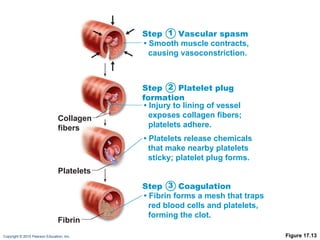 Figure 17.13 Collagen fibers Platelets Fibrin Step  Vascular spasm •   Smooth muscle contracts, causing vasoconstriction. Step  Platelet plug formation •   Injury to lining of vessel exposes collagen fibers; platelets adhere. •   Platelets release chemicals that make nearby platelets sticky; platelet plug forms. Step  Coagulation •   Fibrin forms a mesh that traps red blood cells and platelets, forming the clot. 1 2 3 