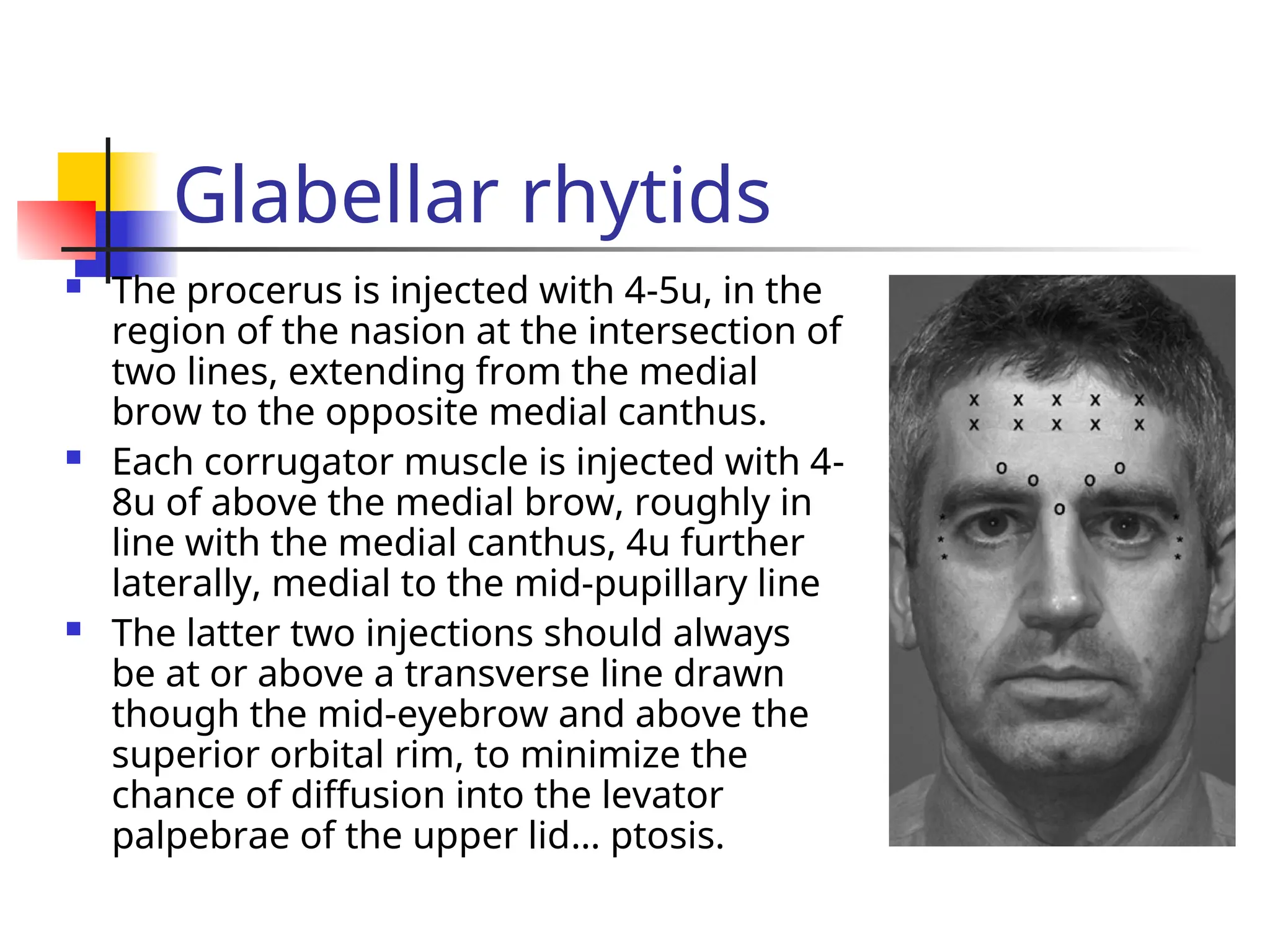 Glabellar rhytids
 The procerus is injected with 4-5u, in the
region of the nasion at the intersection of
two lines, extending from the medial
brow to the opposite medial canthus.
 Each corrugator muscle is injected with 4-
8u of above the medial brow, roughly in
line with the medial canthus, 4u further
laterally, medial to the mid-pupillary line
 The latter two injections should always
be at or above a transverse line drawn
though the mid-eyebrow and above the
superior orbital rim, to minimize the
chance of diffusion into the levator
palpebrae of the upper lid… ptosis.
 