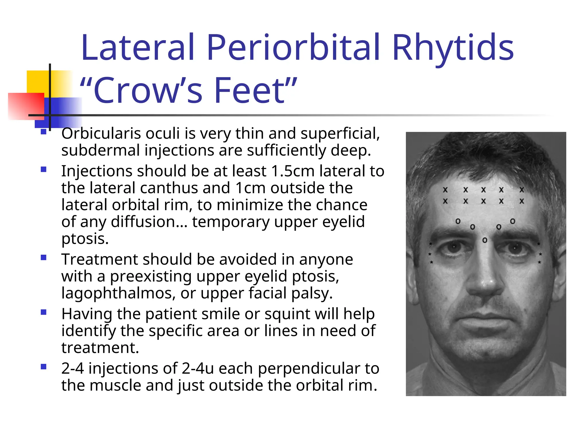 Lateral Periorbital Rhytids
“Crow’s Feet”
 Orbicularis oculi is very thin and superficial,
subdermal injections are sufficiently deep.
 Injections should be at least 1.5cm lateral to
the lateral canthus and 1cm outside the
lateral orbital rim, to minimize the chance
of any diffusion… temporary upper eyelid
ptosis.
 Treatment should be avoided in anyone
with a preexisting upper eyelid ptosis,
lagophthalmos, or upper facial palsy.
 Having the patient smile or squint will help
identify the specific area or lines in need of
treatment.
 2-4 injections of 2-4u each perpendicular to
the muscle and just outside the orbital rim.
 