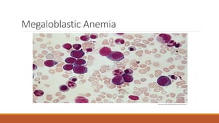 Megaloblastic Anemia
 