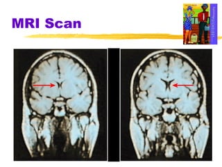 MRI Scan 