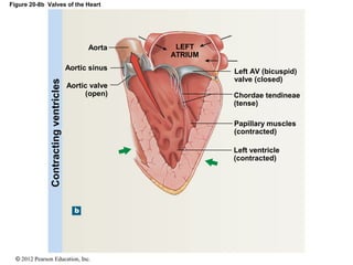 © 2012 Pearson Education, Inc.
Figure 20-8b Valves of the Heart
Contractingventricles
Aorta
Aortic sinus
LEFT
ATRIUM
Aortic valve
(open)
Left AV (bicuspid)
valve (closed)
Chordae tendineae
(tense)
Papillary muscles
(contracted)
Left ventricle
(contracted)
 
